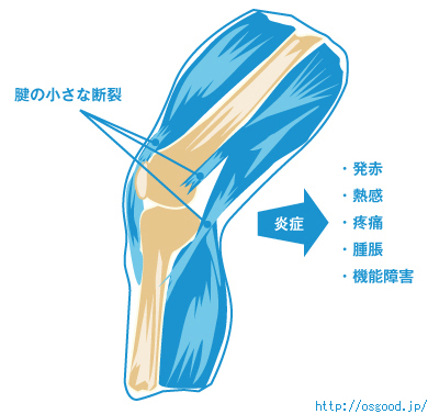 腱の小さな断裂